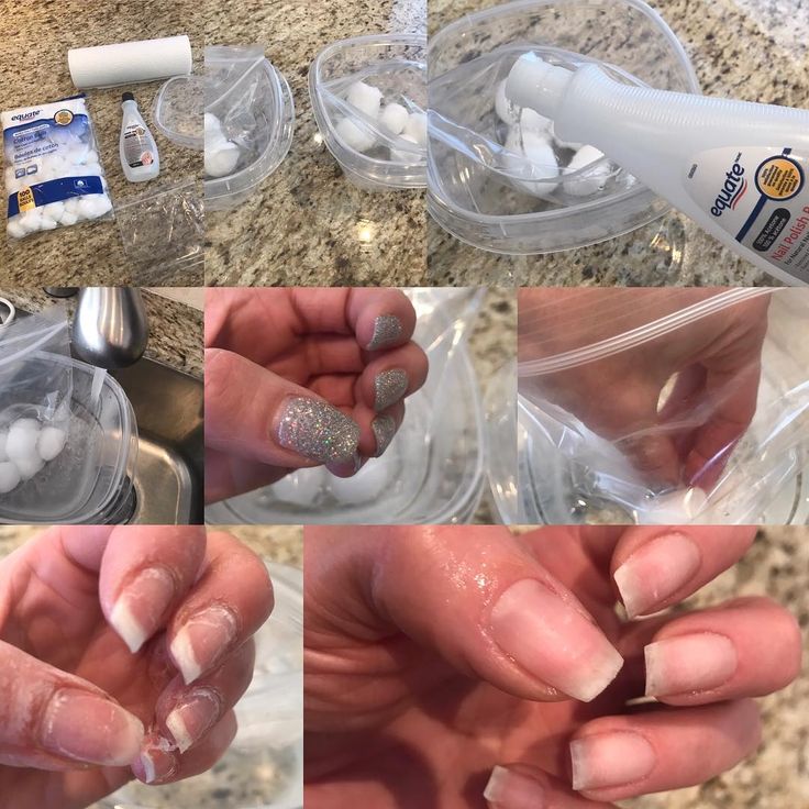 Effective Nail Removal: Achieving a Clean and Refreshed Look with Acetone Soaked Cotton Balls.